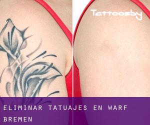 Eliminar tatuajes en Warf (Bremen)