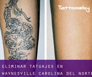 Eliminar tatuajes en Waynesville (Carolina del Norte)