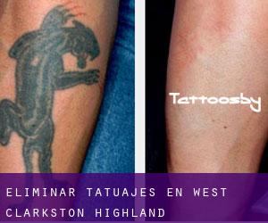 Eliminar tatuajes en West Clarkston-Highland