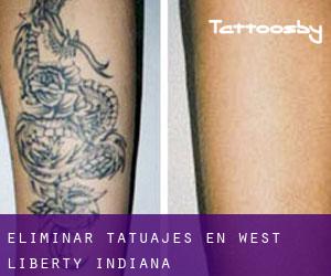 Eliminar tatuajes en West Liberty (Indiana)
