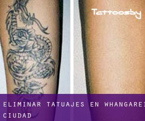 Eliminar tatuajes en Whangarei (Ciudad)