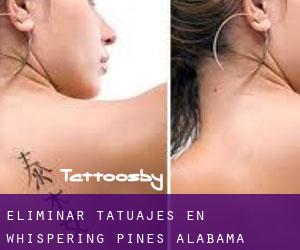Eliminar tatuajes en Whispering Pines (Alabama)