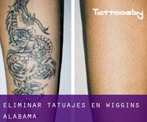 Eliminar tatuajes en Wiggins (Alabama)