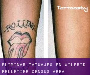 Eliminar tatuajes en Wilfrid-Pelletier (census area)