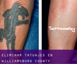 Eliminar tatuajes en Williamsburg County