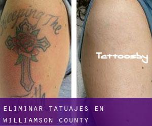 Eliminar tatuajes en Williamson County