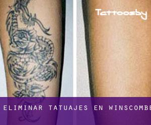 Eliminar tatuajes en Winscombe