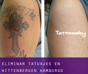 Eliminar tatuajes en Wittenbergen (Hamburgo)