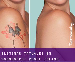 Eliminar tatuajes en Woonsocket (Rhode Island)