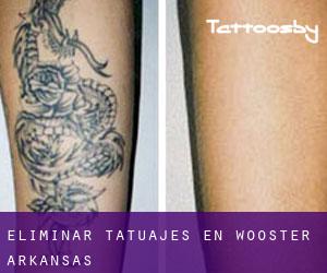 Eliminar tatuajes en Wooster (Arkansas)
