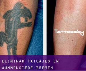 Eliminar tatuajes en Wummensiede (Bremen)