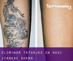 Eliminar tatuajes en Wuxi (Jiangsu Sheng)