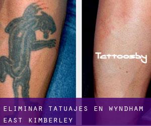 Eliminar tatuajes en Wyndham-East Kimberley