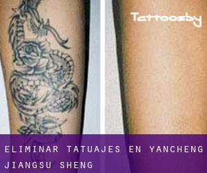 Eliminar tatuajes en Yancheng (Jiangsu Sheng)