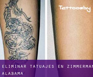 Eliminar tatuajes en Zimmerman (Alabama)
